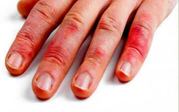 حساسیت به لاتکس چیست؟ علائم آلرژی به لاتکس 
