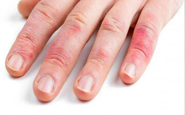 حساسیت به لاتکس چیست؟ علائم آلرژی به لاتکس 