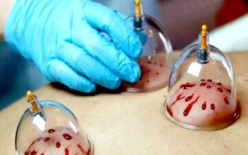 از سردرد تا فشار خون/ معجزه حجامت زیر ذره‌بین