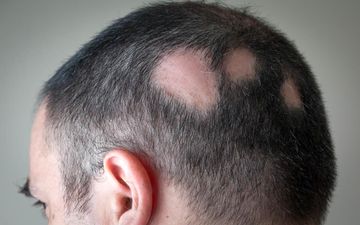 درباره  کچلی سکه ای چه میدانید؟