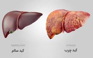 کم آبی دشمن کبد شماست​