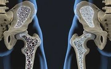 تفاوت‌های پوکی و نرمی استخوان