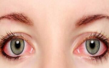 لکه های خونی در چشم چه علتی دارد؟
