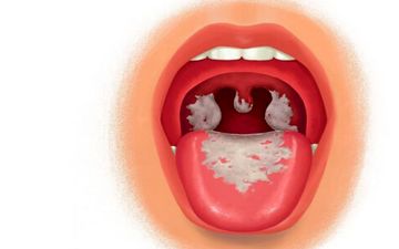 دیفتری چیست؟ | هر آنچه باید در مورد دیفتری بدانید

