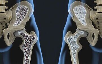 محکم شدن استخوان‌ها با این ماده معدنی

