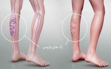 درمان های خانگی برای واریس