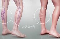 خطر ابتلا به واریس با کمبود این ویتامین چند برابر می‌شود