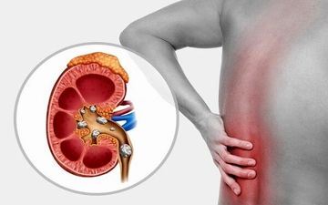 چه چیزهایی باعث سنگ ساز شدن کلیه ها می شود؟