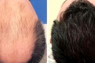 آیا کاشت مو برای همیشه می‌ماند یا دوباره می‌ریزد؟
