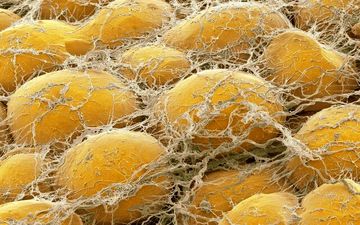 بررسی رابطه چاقی و مشکلات کلیوی در دیابتی ها