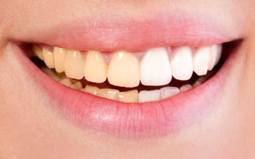 این اشتباهات دندان‌هایتان را زرد می‌کند