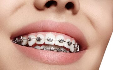 بهتر است در مورد ارتودنسی این موارد را بدانید