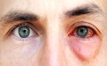 چگونه در مواقع انفجار از چشم و گوش خود مراقبت کنیم؟