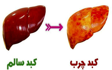 نشانه‌های اولیه کبد چرب که باید بدانید