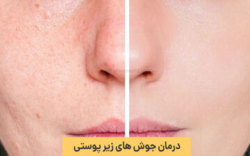 جوش زیر پوستی رو با این روش‌ها از بین ببر! 