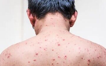 علائم آبله مرغان در بزرگسالی را بشناسید