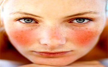  سرخ شدن صورت| علت و نشانه‌های سرخ شدن صورت چیست؟