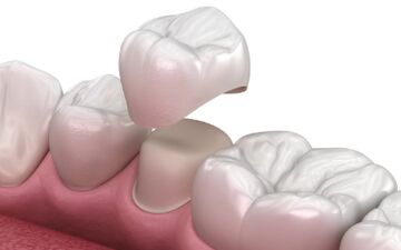 روکش دندان برای چه افرادی مناسب است؟