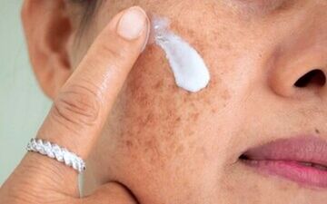 
لکه‌های پوستی را چگونه درمان کنیم؟