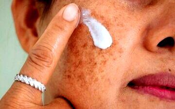 
لکه‌های پوستی را چگونه درمان کنیم؟