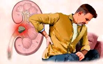 آیا مصرف کلسیم باعث سنگ کلیه می‌شود؟