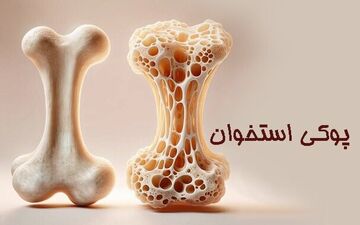 زنان بیش از مردان در معرض ابتلا به پوکی استخوان هستند