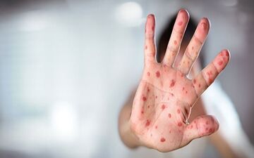 واکسیناسیون، سپر اصلی در برابر تهدید سرخک