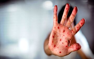 واکسیناسیون، سپر اصلی در برابر تهدید سرخک