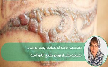 کلوئید، شایع ترین عوارض تاتو