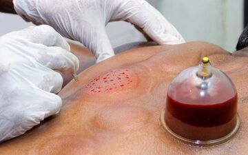 حجامت می‌تواند جایگزین واکسن کرونا باشد؟