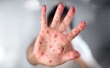 خطر ابتلا به بیماری سرخک در کمین شهروندان

