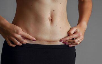 زخم‌های ناشی از سزارین چگونه بهبود می‌یابند؟
