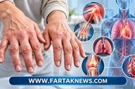 بیماری بافت همبند مختلط چیست؟ اختلال خودایمنی با علائم چند بیماری روماتیسم