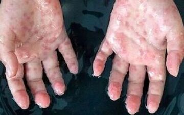 مراقبت مرزی برای مقابله با آبله میمون