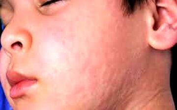 در حساسیت‌های پوستی،بهترین کار چه کاریست؟! 