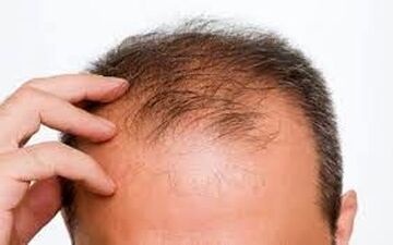 راهکارهایی برای جلوگیری از ریزش مو