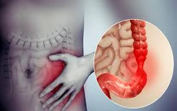 عوامل ایجاد سندروم روده تحریک پذیر