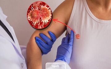 سن ابتلا به سرطان پستان از چندسالگی آغاز میشود؟