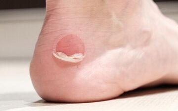 از تاول زدن چگونه پیشگیری کنیم؟