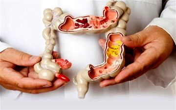 رژیم غذایی پرچرب و آنتی‌‌بیوتیک، عوامل مهم بروز بیماری‌‌های التهابی روده