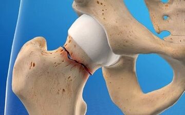 پیشگیری از شکستگی های مکرر با درمان به موقع پوکی استخوان