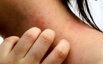 چرا پوستمان دچار بثورات می‌شود؟ از نیش حشرات تا بیماری‌های خودایمنی