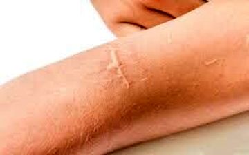 چگونه جای زخم‌های کهنه پوست را درمان کنیم؟