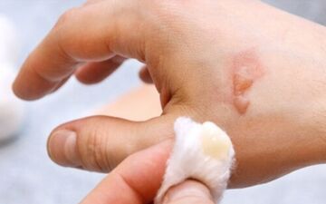 اگر بدنم سوخت چکار کنم؟ | 4 راه برای بهبود زخم پس از سوختگی

