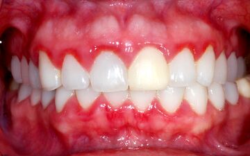 مهم ترین دلایل خونریزی لثه/نقش داروهای خاص 