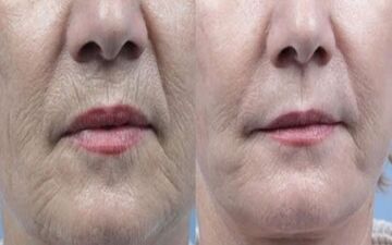 چگونه چین و چروک‌های دور لب را از بین ببریم؟