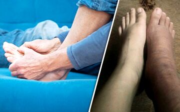 تورم مچ پا نشانه‌ای هشدار دهنده از وجود این بیماری
