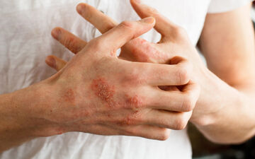  آنچه باید درباره اگزما بدانیم+اینفوگرافیک