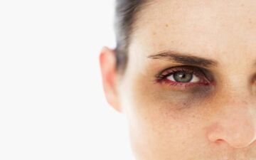 سیاهی دور چشم به چه علت است؟
