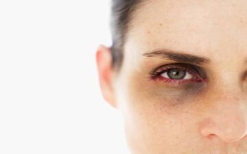 سیاهی دور چشم به چه علت است؟

